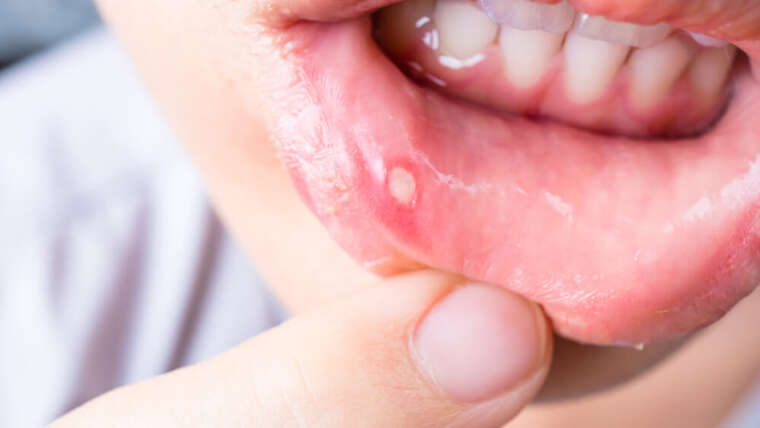 Oral & Genital ulcer