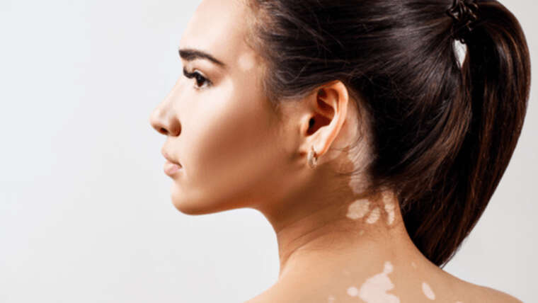 Vitiligo
