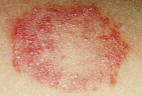 Skin infection (Fungal, Bacterial, Viral, Parasitic)